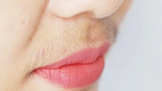 Psoriasis