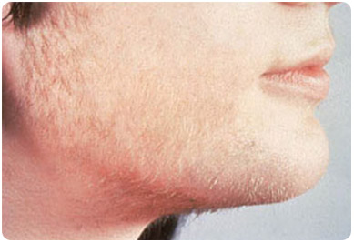 Psoriasis